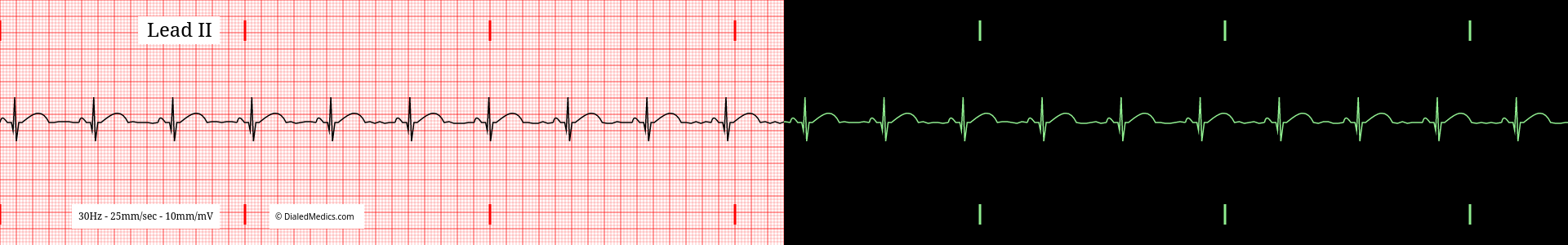 Normal Sinus Rhythm at a heart rate of 62bpm EKG example, split printout / monitor display.