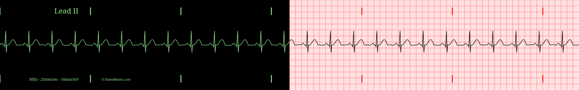 Normal Sinus Rhythm at a heart rate of 78bpm EKG example, split printout / monitor display.