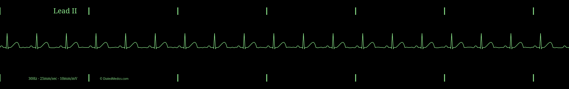 Cardiac monitor capture showing an EKG of Normal Sinus Rhythm with a heart rate of 60bpm.