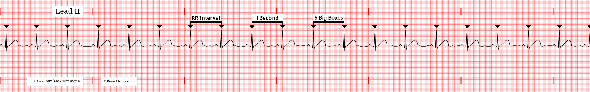 Software generated EKG tracing of a Normal Sinus Rhythm at 60bpm with an RR Interval of 25mm / 1sec marked.