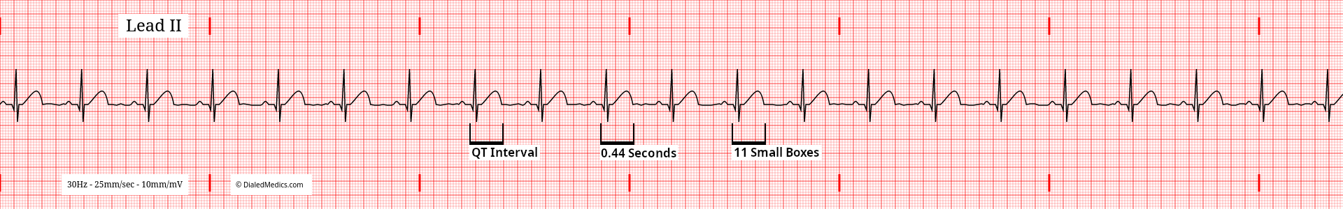 EKG / ECG tracing of a Normal Sinus Rhythm at 64bpm with QT Intervals marked and measured to 11mm (small boxes) or 440ms.