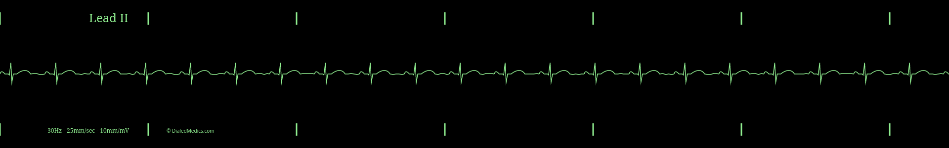 Software generated Normal Sinus Rhythm EKG tracing with a HR of 66.