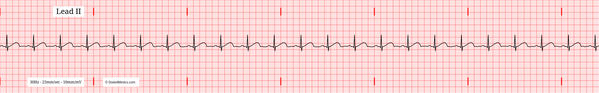 Software generated Normal Sinus Rhythm EKG tracing with a HR of 70.