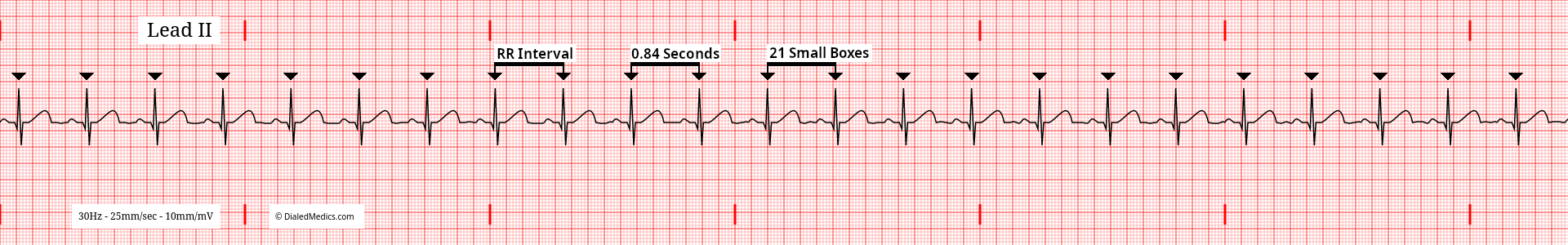 Software generated EKG tracing of a Normal Sinus Rhythm at 72bpm with an RR Interval of 21mm / 0.84sec marked.