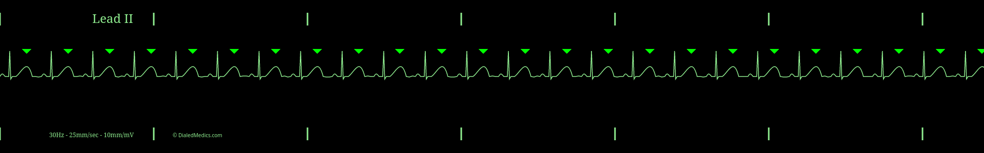 Software generated Normal Sinus Rhythm at a rate of 74bpm with T Waves marked by green triangles.