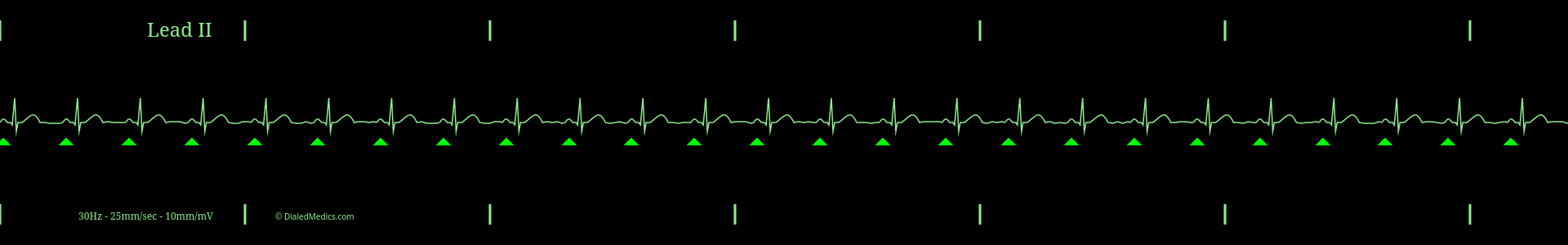 Software generated Normal Sinus Rhythm at a rate of 76bpm with P Waves marked by green triangles.