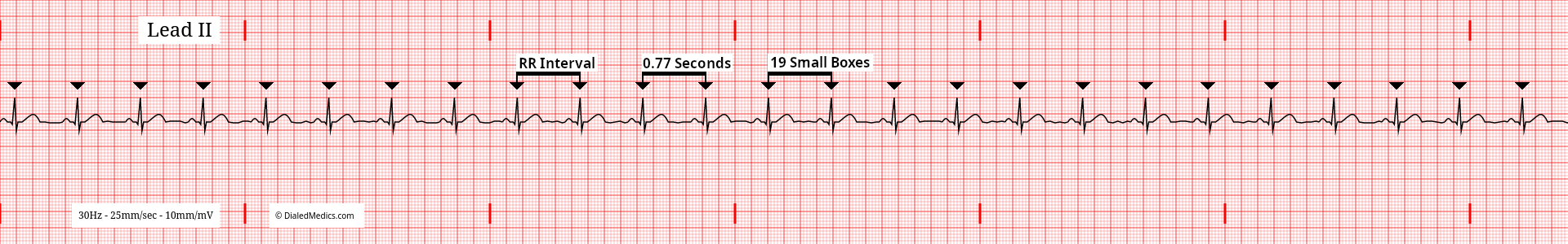 Software generated EKG tracing of a Normal Sinus Rhythm at 78bpm with an RR Interval of 19mm / 0.77sec marked.