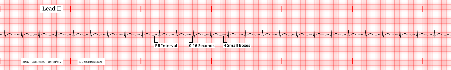 EKG / ECG tracing of a Normal Sinus Rhythm with expected PR Intervals marked and measured to 4mm (small boxes) or 160ms.