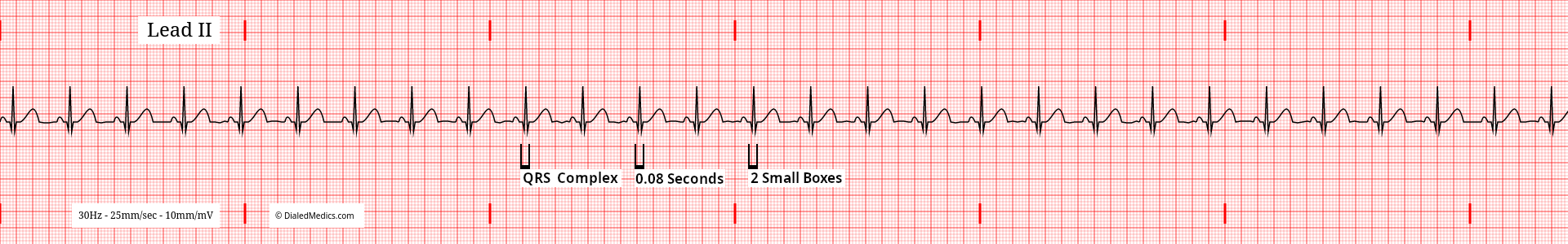 EKG / ECG tracing of a Normal Sinus Rhythm at 86bpm with expected QRS complex durations marked and measured to 2mm (small boxes) or 80ms.