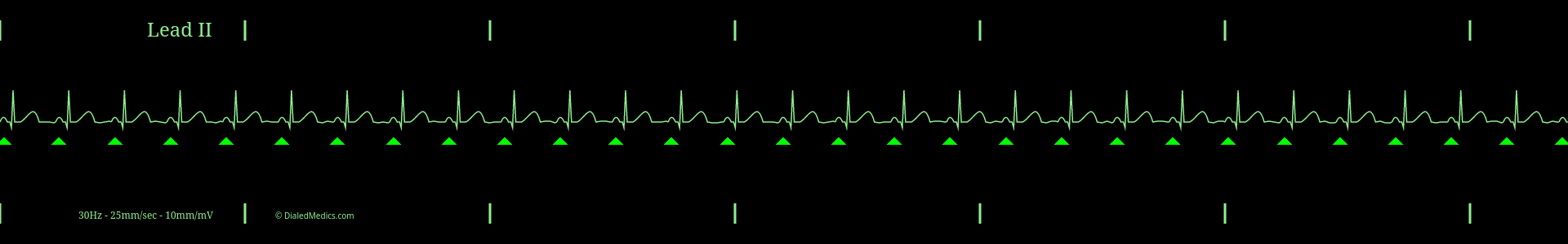 Software generated Normal Sinus Rhythm at a rate of 88bpm with P Waves marked by green triangles.