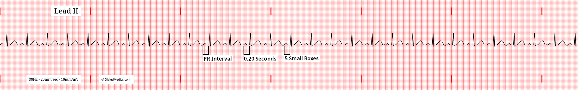 EKG / ECG tracing of a Normal Sinus Rhythm at 89bpm with expected PR Intervals marked and measured to 5mm (small boxes) or 200ms.