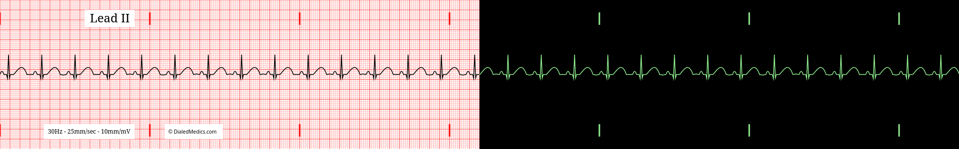 Normal Sinus Rhythm at a heart rate of 90bpm EKG example, split printout / monitor display.