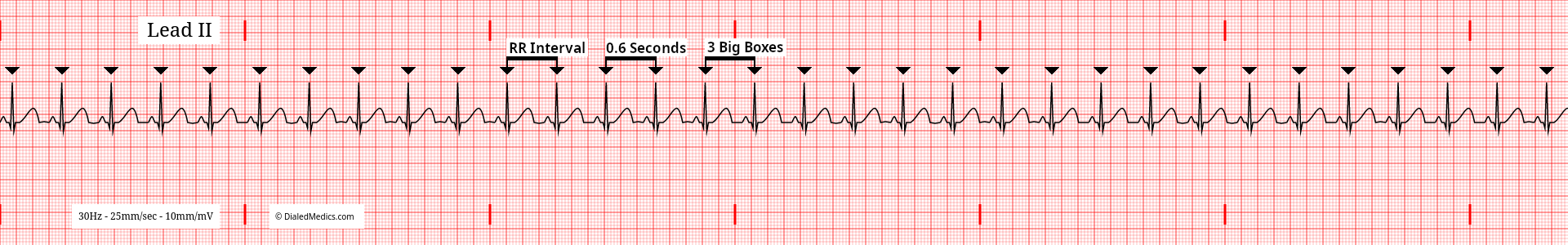 Software generated EKG tracing of a Normal Sinus Rhythm at 99bpm with an RR Interval of 15mm / 60ms marked.