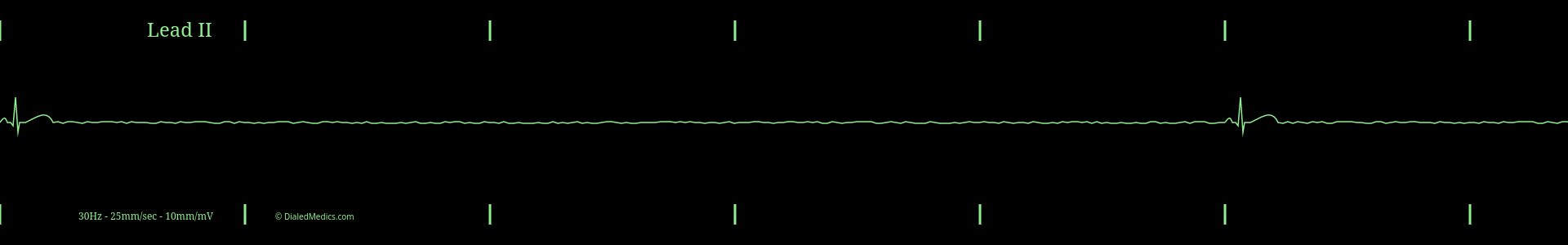 Cardiac monitor capture showing an EKG of Sinus Bradycardia with a heart rate of 4bpm.