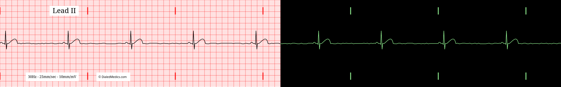 Sinus Bradycardia ECG example, split printout / monitor display.