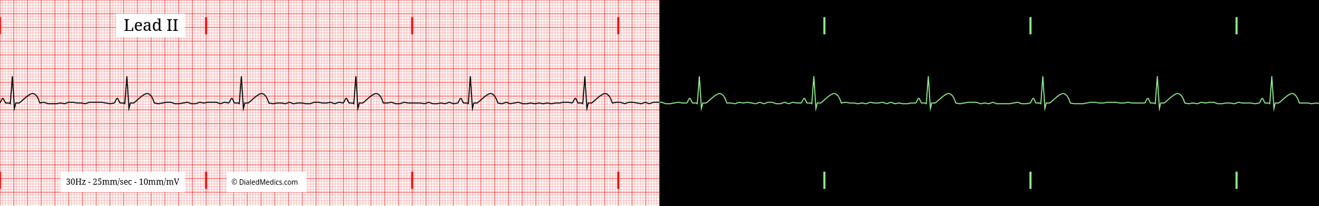 Sinus Bradycardia ECG example, split printout / monitor display.