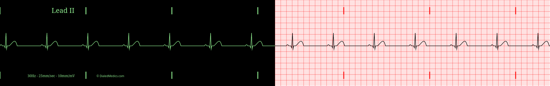 Sinus Bradycardia ECG example, split printout / monitor display.