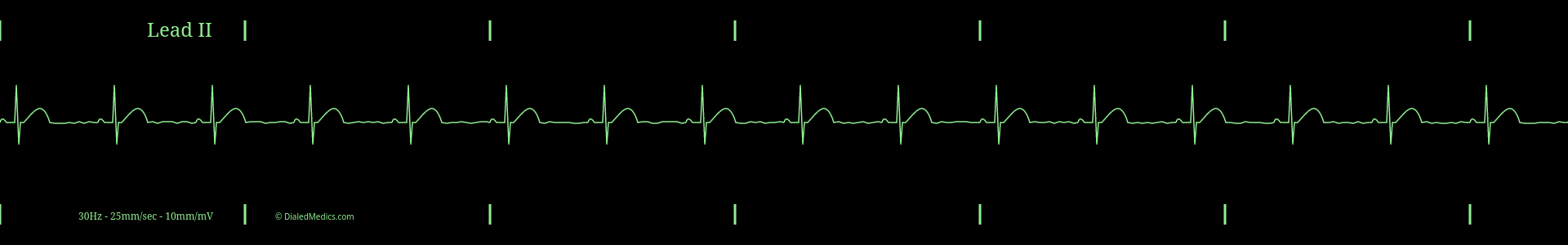 Cardiac monitor capture showing an EKG of Sinus Bradycardia with a heart rate of 50bpm.