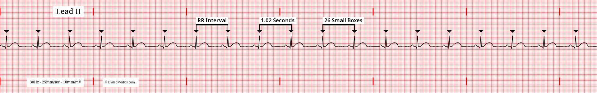 Software generated EKG tracing of a Sinus Bradycardia at 59bpm with an RR Interval of 26mm / 102ms marked.