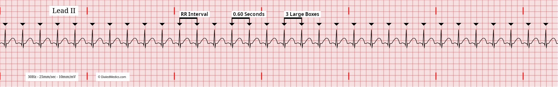 Software generated EKG tracing of a Sinus Tachycardia at 100bpm with an RR Interval of 15mm / 600ms marked.