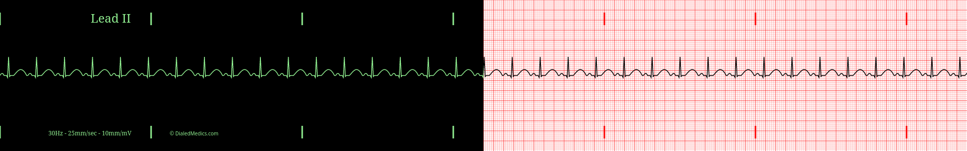 Sinus Tachycardia ECG example with a heart rate of 108bpm, split printout / monitor display.