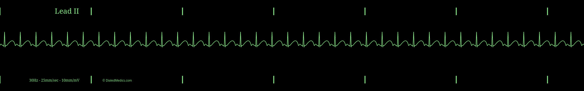 Cardiac monitor capture showing an EKG of Sinus Tachycardia with a heart rate of 116bpm.