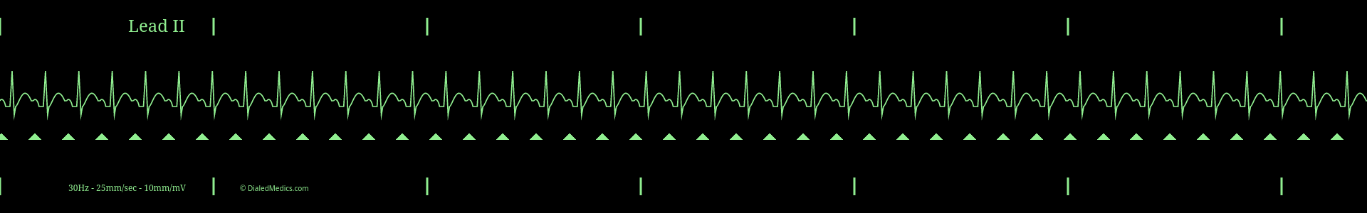 Cardiac monitor capture showing an EKG of Sinus Tachycardia with a heart rate of 128bpm and P Waves marked with green triangles.