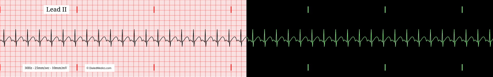 Sinus Tachycardia ECG example with a heart rate of 130bpm, split printout / monitor display.