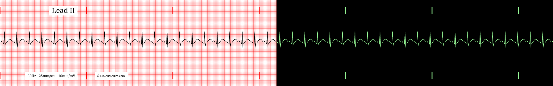 Sinus Tachycardia ECG example with a heart rate of 138bpm, split printout / monitor display.