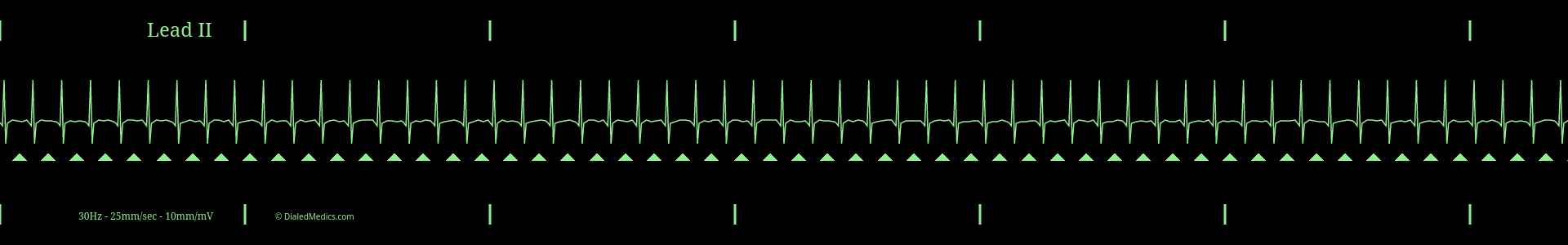 Cardiac monitor capture showing an EKG of Supraventricular Tachycardia with a heart rate of 170bpm.