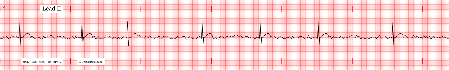 The Atrial Fibrillation (AFib) EKG/ECG