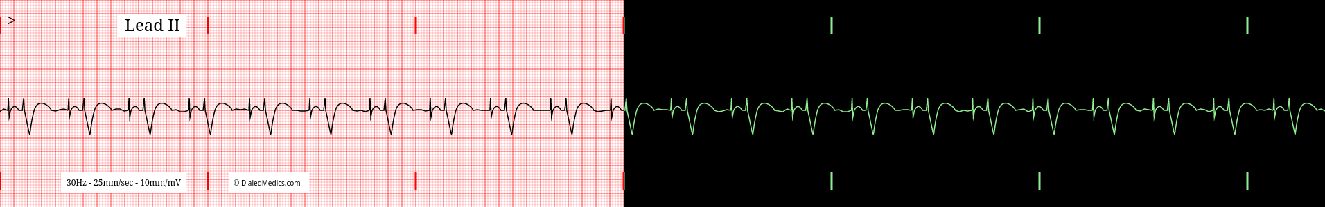The Atrio-Ventricular Pacemaker EKG/ECG