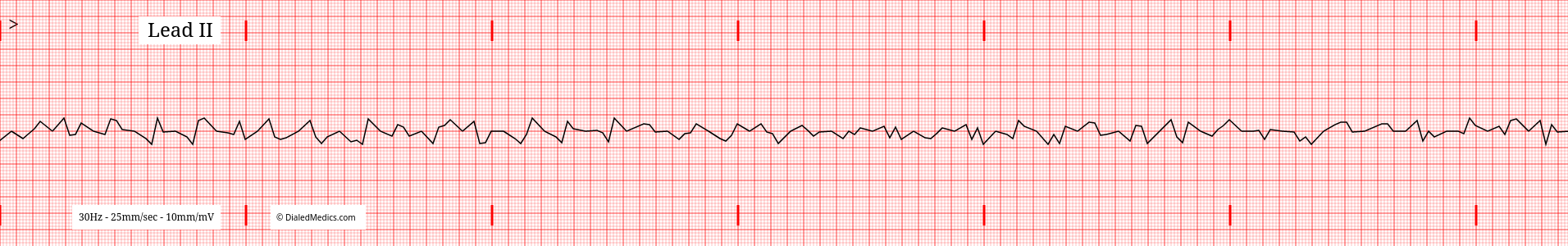 The Ventricular Fibrillation (VFib) EKG/ECG