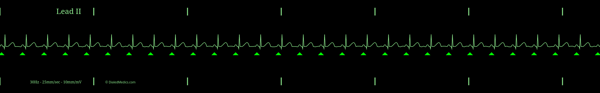 The Normal Sinus Rhythm (NSR) ECG/EKG