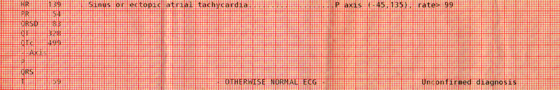 Computer EKG interpretation, sinus or ectopic atrial tachycardia, otherwise normal ECG, unconfirmed diagnosis.