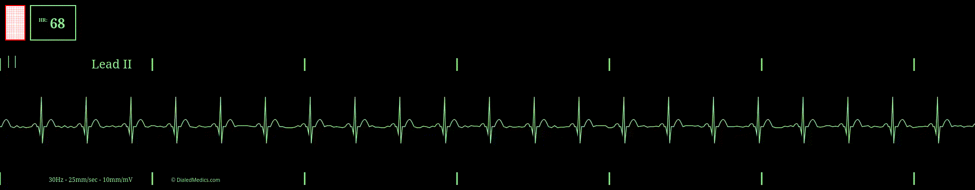 EKG monitor simulation of normal sinus rhythm at a rate of 68bpm.