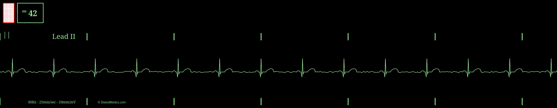 EKG monitor simulation of sinus bradycardia at a rate of 42bpm.