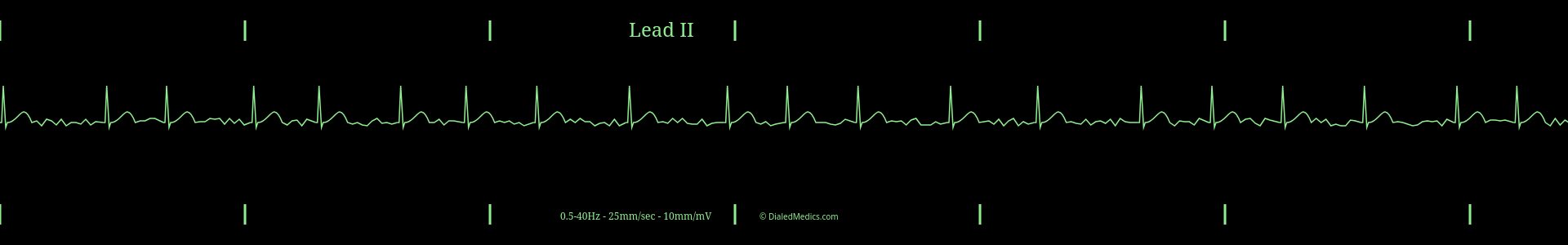 Example EKG monitor capture of an Atrial Fibrillation with a heart rate around 70bpm.