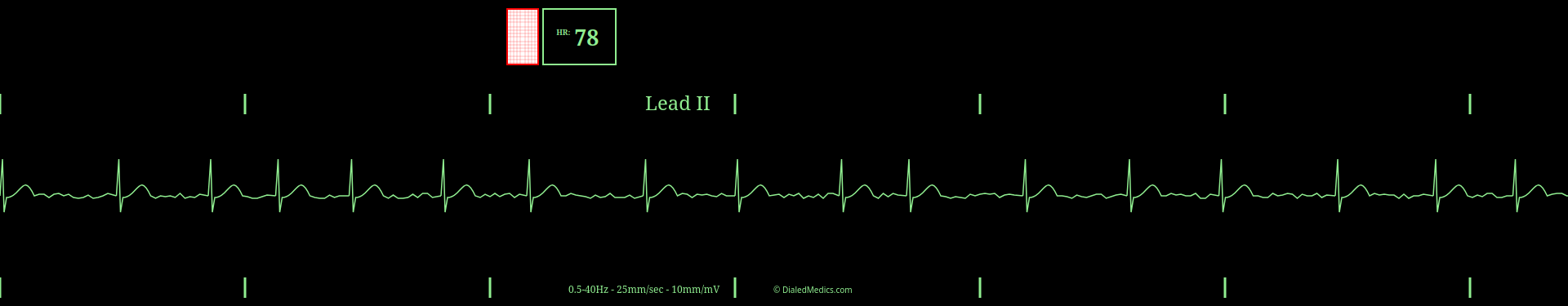 A capture of Dialed Medics ECG generator / simulator output showing Atrial Fibrillation.