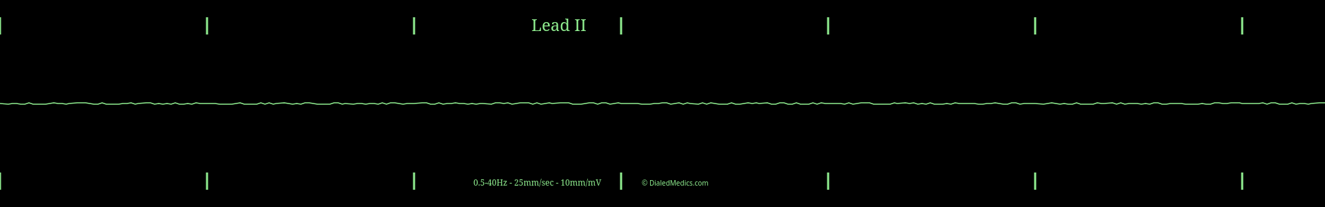 Example EKG monitor capture of an Asystole.