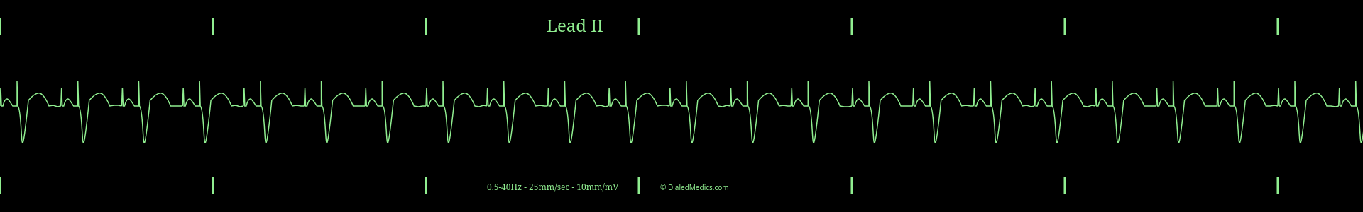 Example EKG monitor capture of an Atrio-Ventricularly Paced Rhythm with a rate of 70bpm.