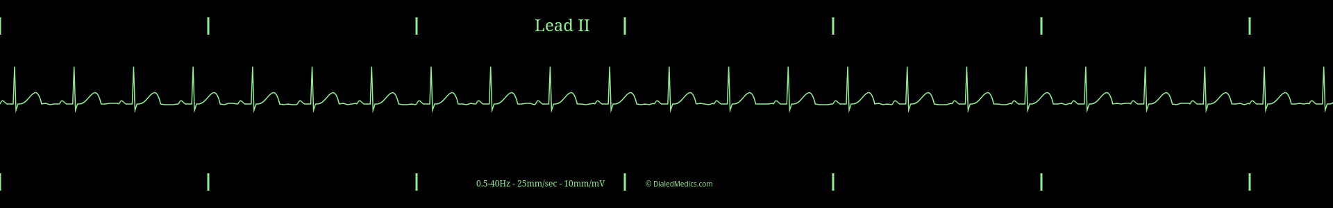 Example EKG monitor capture of a Normal Sinus Rhythm with a heart rate of 70bpm.