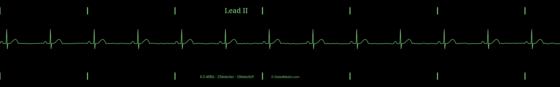 Example EKG monitor capture of a Sinus Bradycardia with a heart rate of 40bpm.