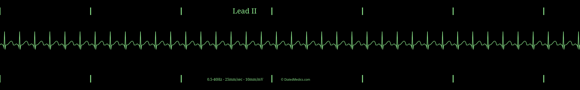 Example EKG monitor capture of a Sinus Tachycardia with a heart rate of 120bpm.