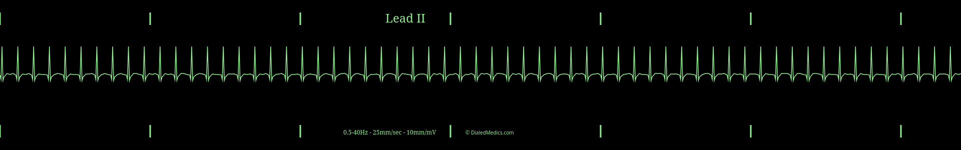 Example EKG monitor capture of a Supraventricular Tachycardia (SVT) with a heart rate of 190bpm.