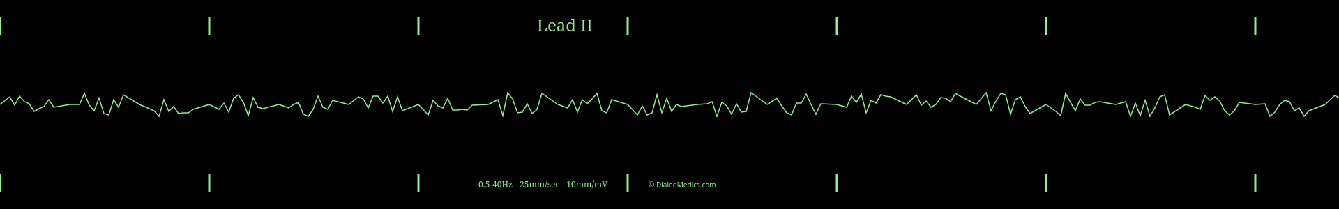 Example ECG monitor capture of a Ventricular Fibrillation.