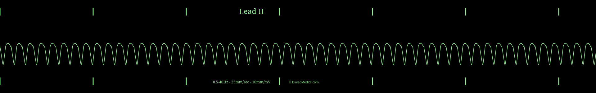 Example ECG monitor capture of a Ventricular Tachycardia with a heart rate of 167bpm.