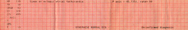 Computer EKG interpretation, sinus or ectopic atrial tachycardia, otherwise normal ECG, unconfirmed diagnosis.