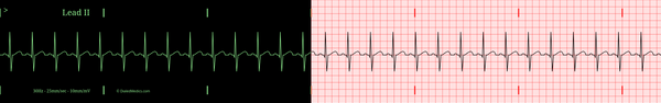 The Normal Sinus Rhythm Nsr Ekgecg 