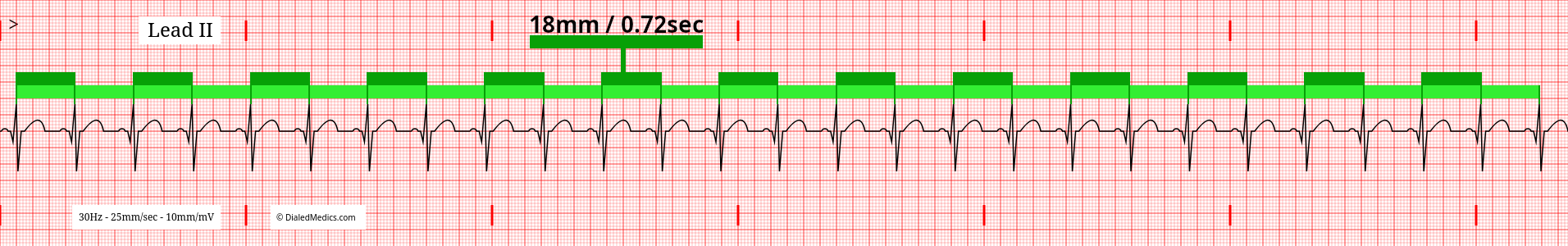 The Normal Sinus Rhythm (NSR) EKG/ECG